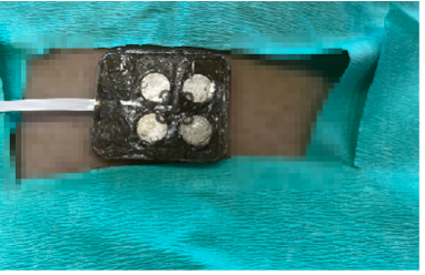 Flexible integrated ultrasound device positioned on the body in an experimental monitoring setup